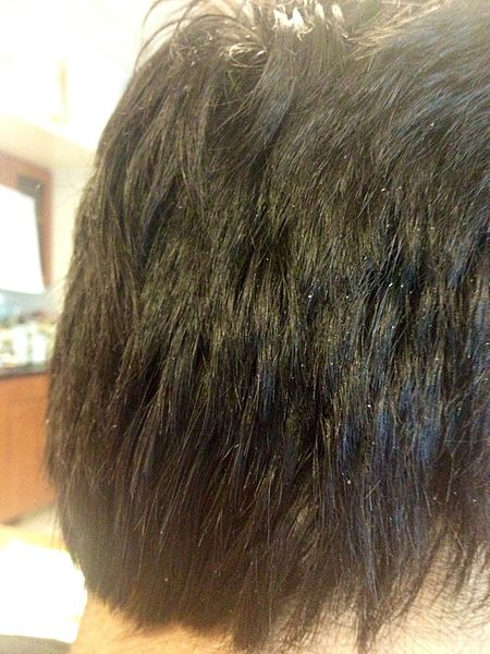 Problems With Dandruff? the Causes and Remedies to Eliminate the Disorder“