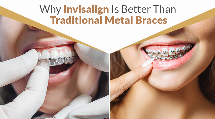 Why Invisalign Is Better Than Traditional Metal Braces
