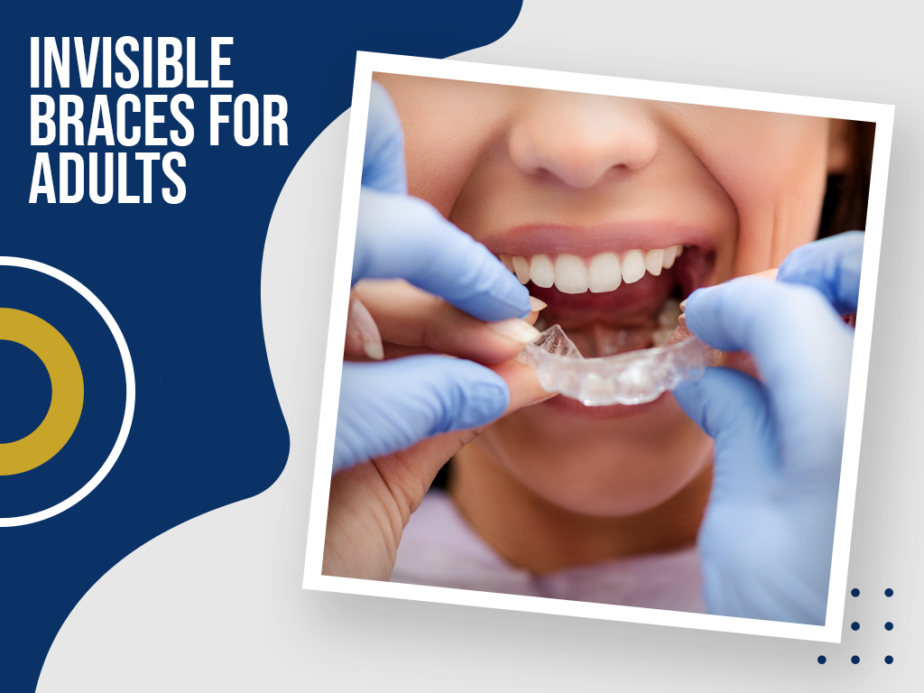 Invisible Braces for Adults