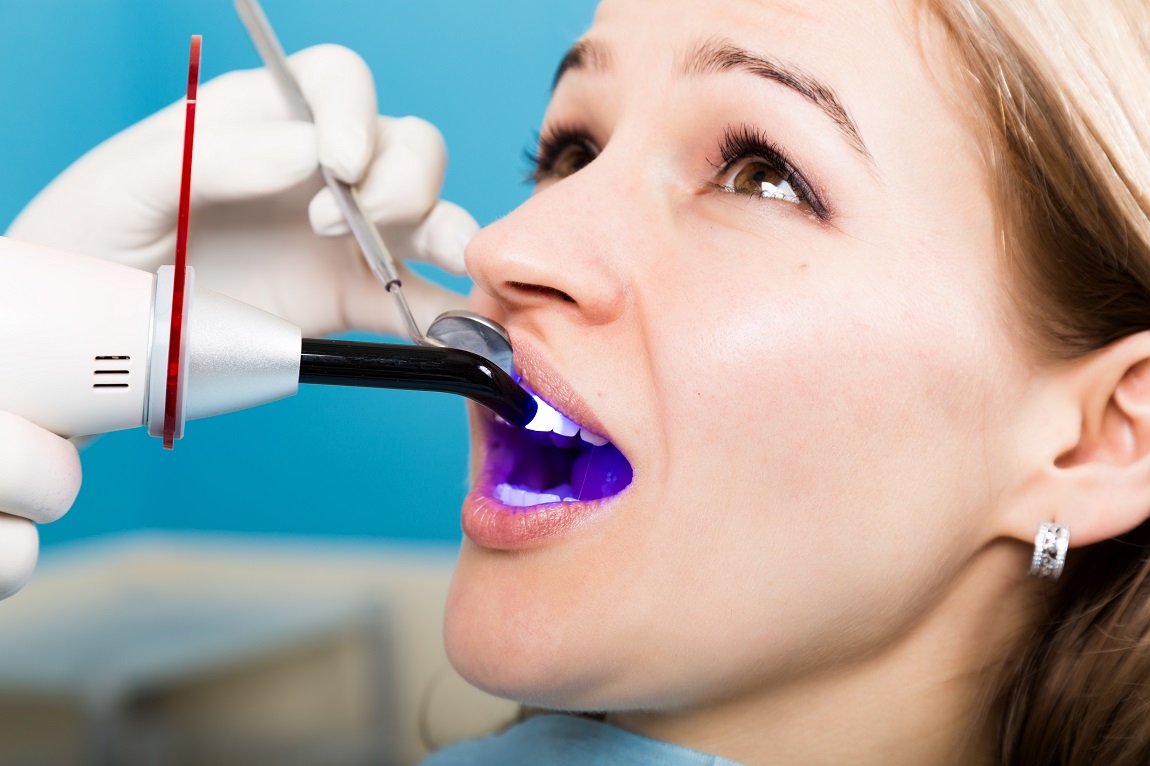 What You Should Know About Teeth Bonding