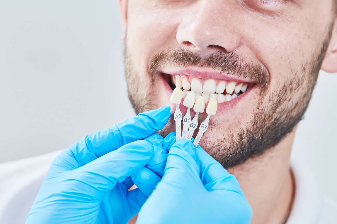 Dental Veneers to Get Beautiful Teeth
