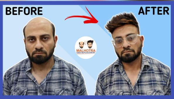 Worried about Where to Get Hair Patch for Men?