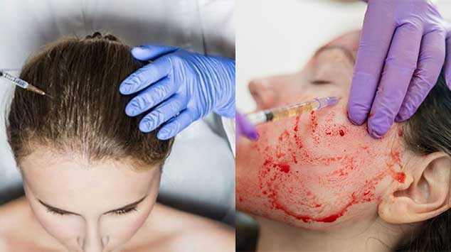 Best 5 Benefits of Prp