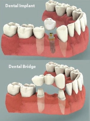 Denture vs Dental Implants What Is Best?