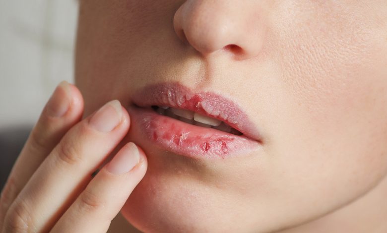 Cure Lip Infection by Using the Antifungal Cream for Lips