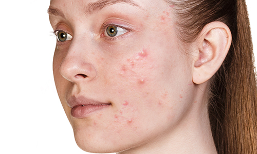 Are You Have an Acne Scar? Tips Are Waiting for You