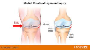 Prevention of MCL Sprain