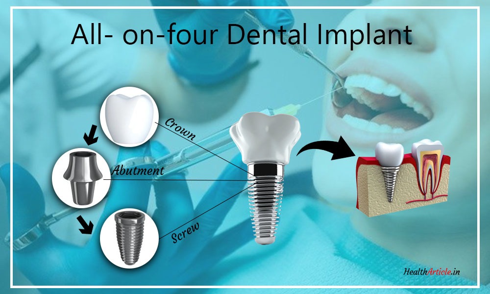 All-On-Four Dental Implant Cost in Chennai