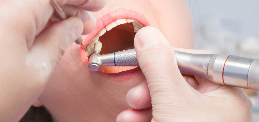 Why You Need Professional Teeth Cleaning