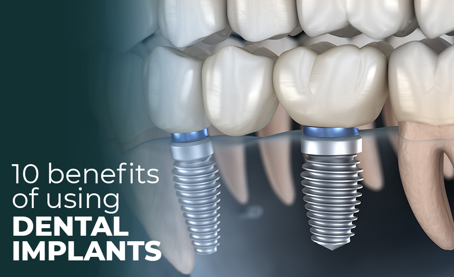 10 Benefits of Using Dental Implants