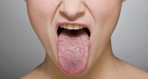 Dental Effects of Constant Dry Mouth
