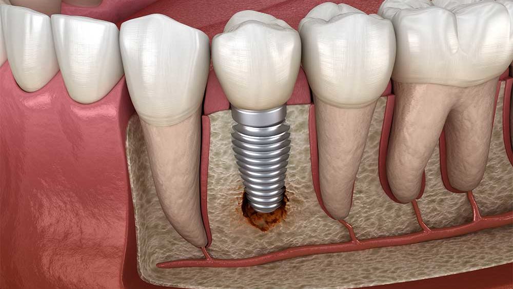 How Long Do Dental Implants Last and Can They Fail?