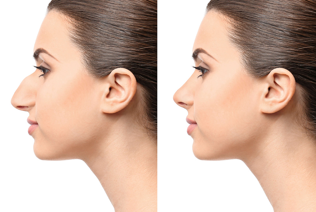 Rhinoplasty: An Ultimate Guide for 2022