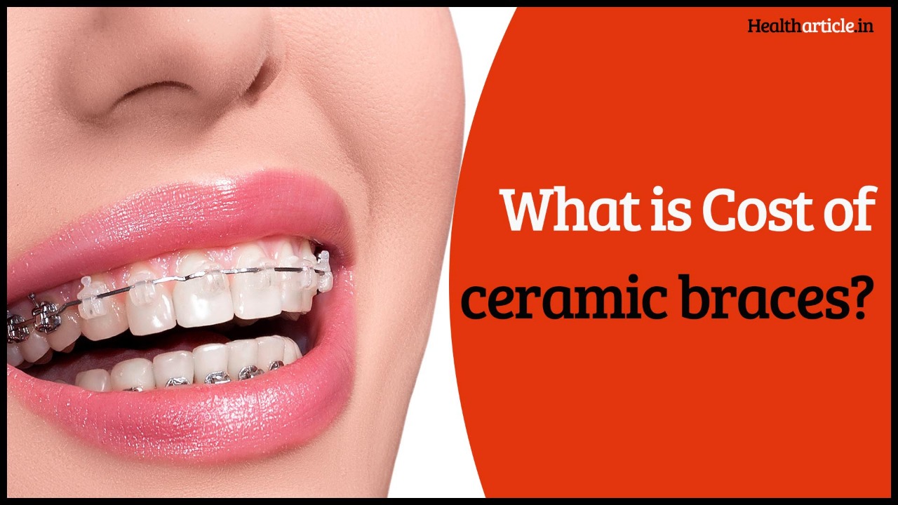 Ceramic Braces Cost