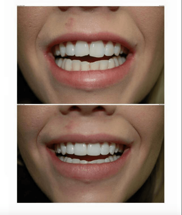 The Top 5 Advantages of Cosmetic Dental Bonding for Crooked Teeth