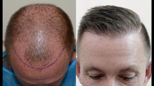 How Effective Is Hair Transplantation Cost in Jaipur