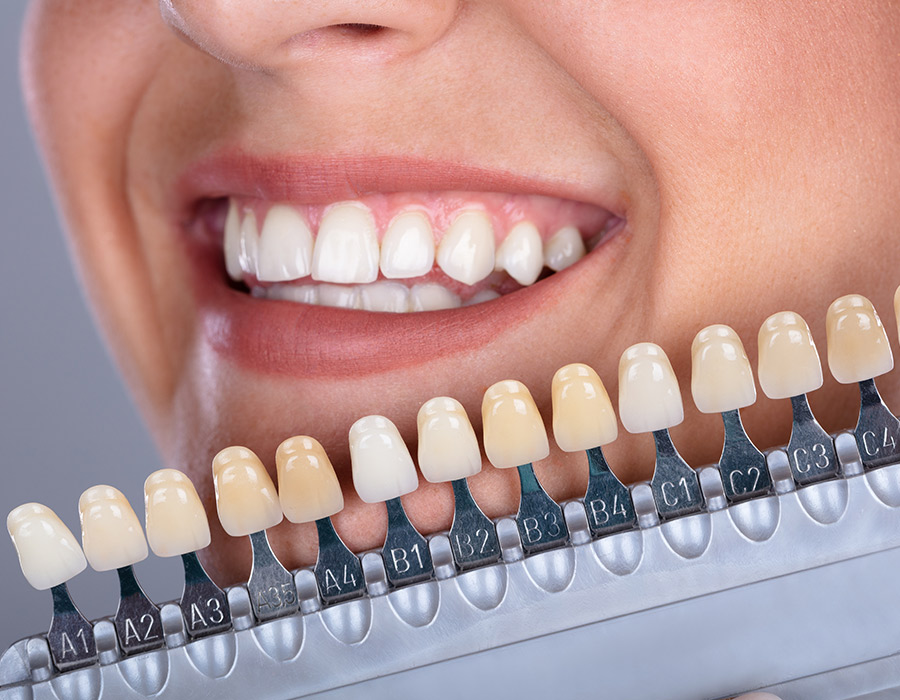 How Much Do Dental Veneers and Lumineers Cost in Dubai?