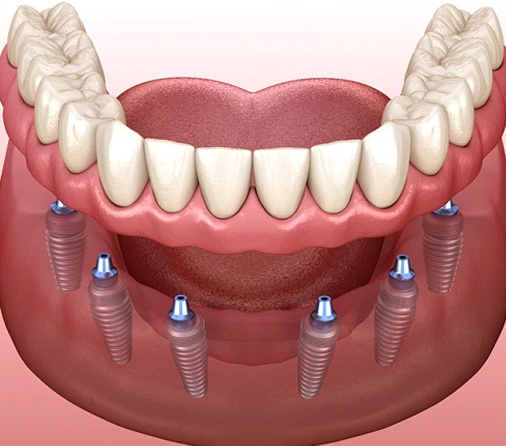 Implant Retained Denture - Pros, Cons & Bottom Line