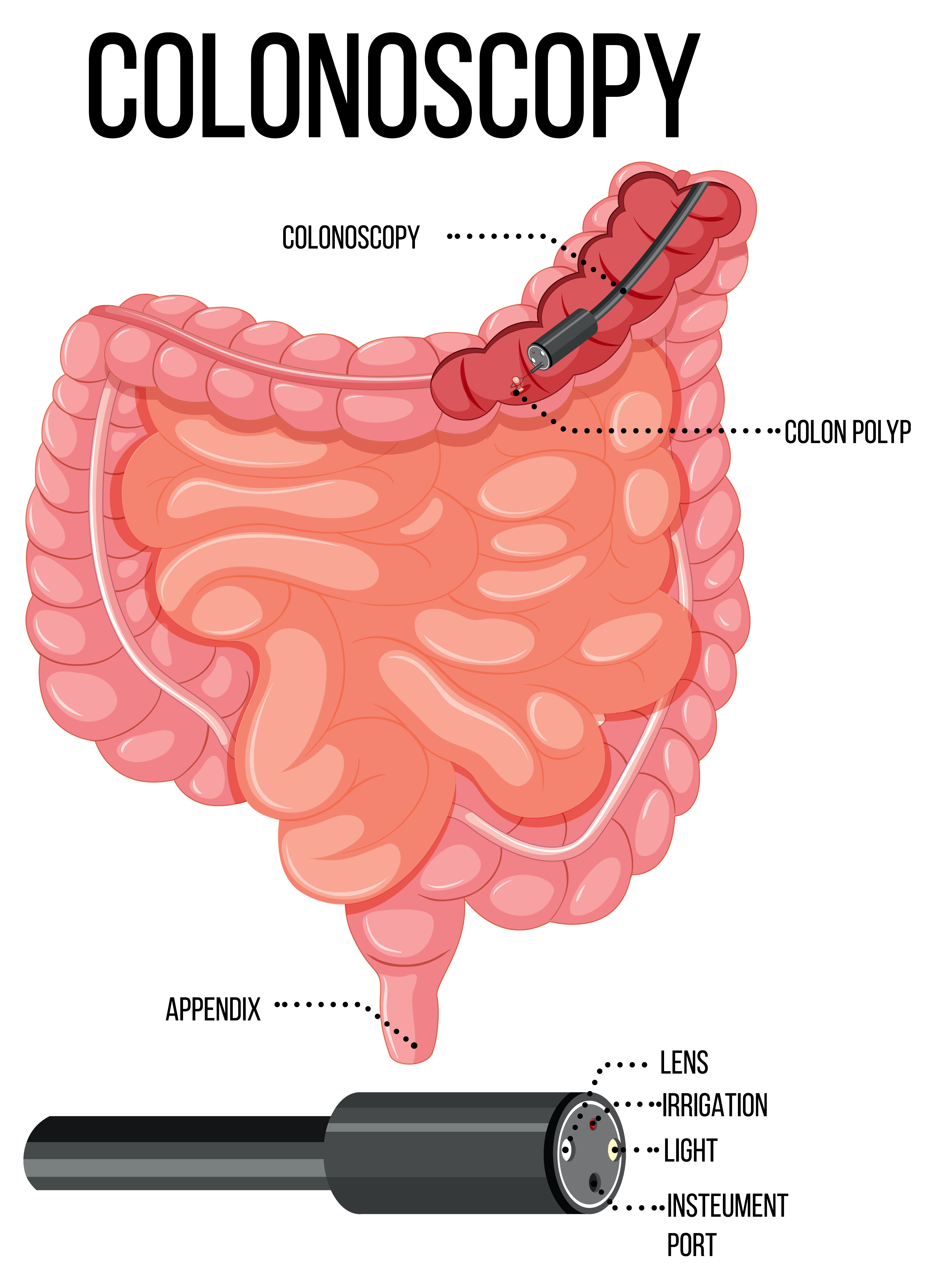 What Are the Factors That Affect the Cost of Colonoscopy Test in India?