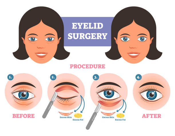 Guide To Eye Lid Surgery: What It Is The Recovery Process and Its After-Effects?