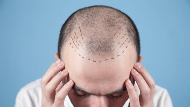 Hair Transplant Results: Factors That Influence Success