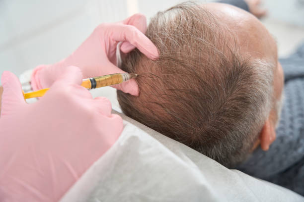 How PRP Hair Treatment Improves Hair Density Naturally