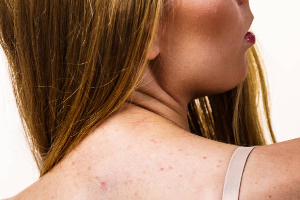 How to Treat Back Acne When Over-the-Counter Care Fails