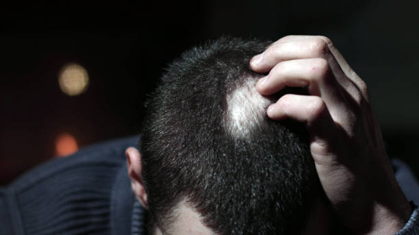 Alopecia Areata Treatment and the Importance of Early Evaluation