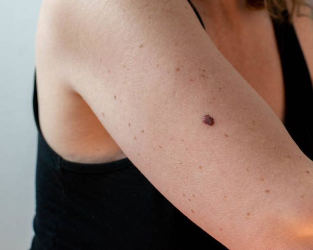 Mole Removal and Mole Monitoring: Essential Skin Health Tips