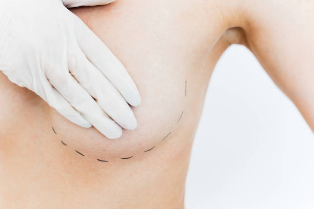 How to Choose a Qualified Silicone Breast Implant Surgeon