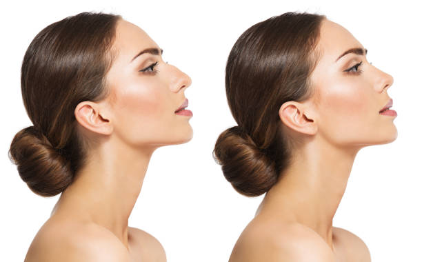 Rhinoplasty Explained for Patients Considering Nose Surgery